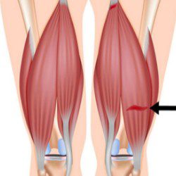 Hamstring Strain illustration