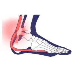 Achilles tendonitis