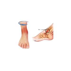 Ankle Sprain