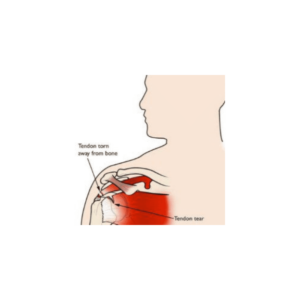 Rotator Cuff Strain