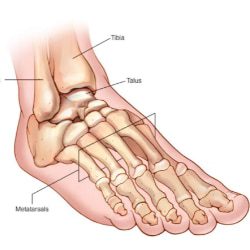 Metatarsal stress fracture